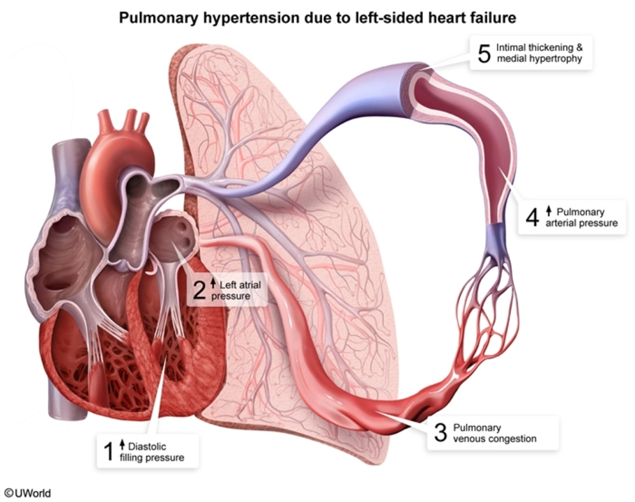 The Connection Between Pulmonary Arterial Hypertension and Rheumatoid Arthritis